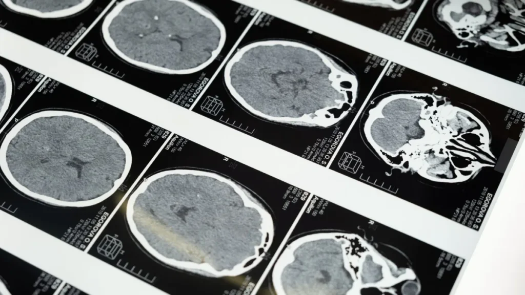 A series of brain MRI images displayed on a lightbox