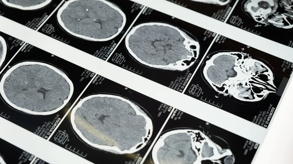 A series of brain MRI images displayed on a lightbox