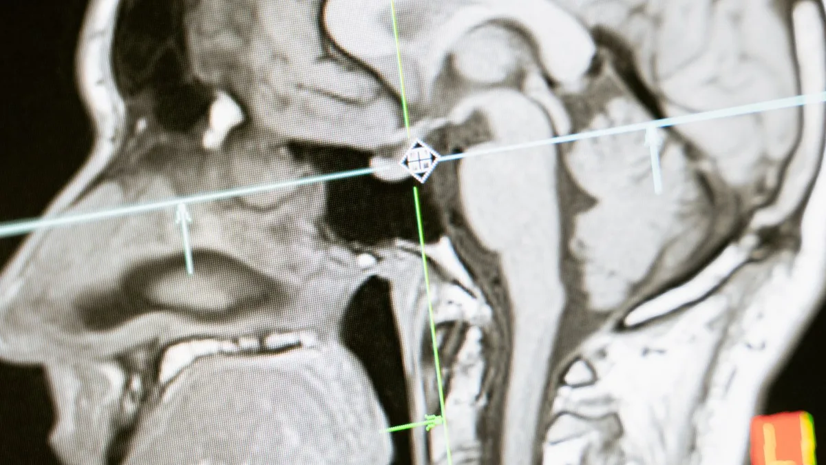 A close-up sagittal MRI scan of a human brain