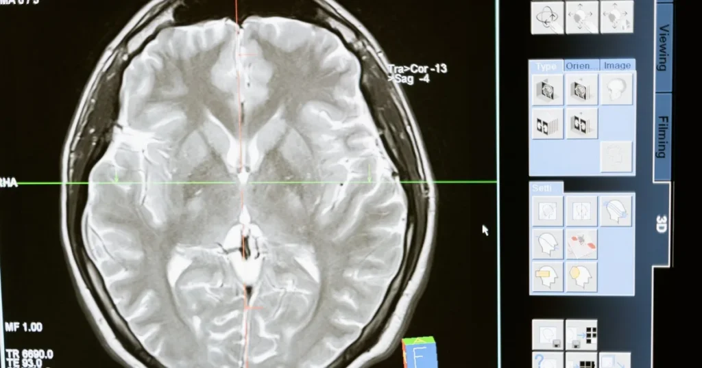 An MRI brain scan displayed on a computer monitor during medical review